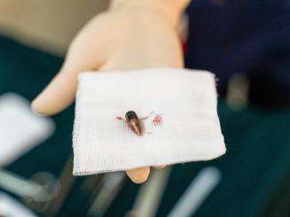 A hand holding a bullet extracted from a patient in Sudan.