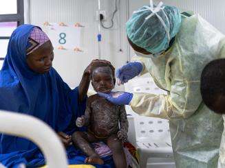A young measles patient is treated with zinc ointment at the MSF Nilefa Kiji facility in Maiduguri, Nigeria.