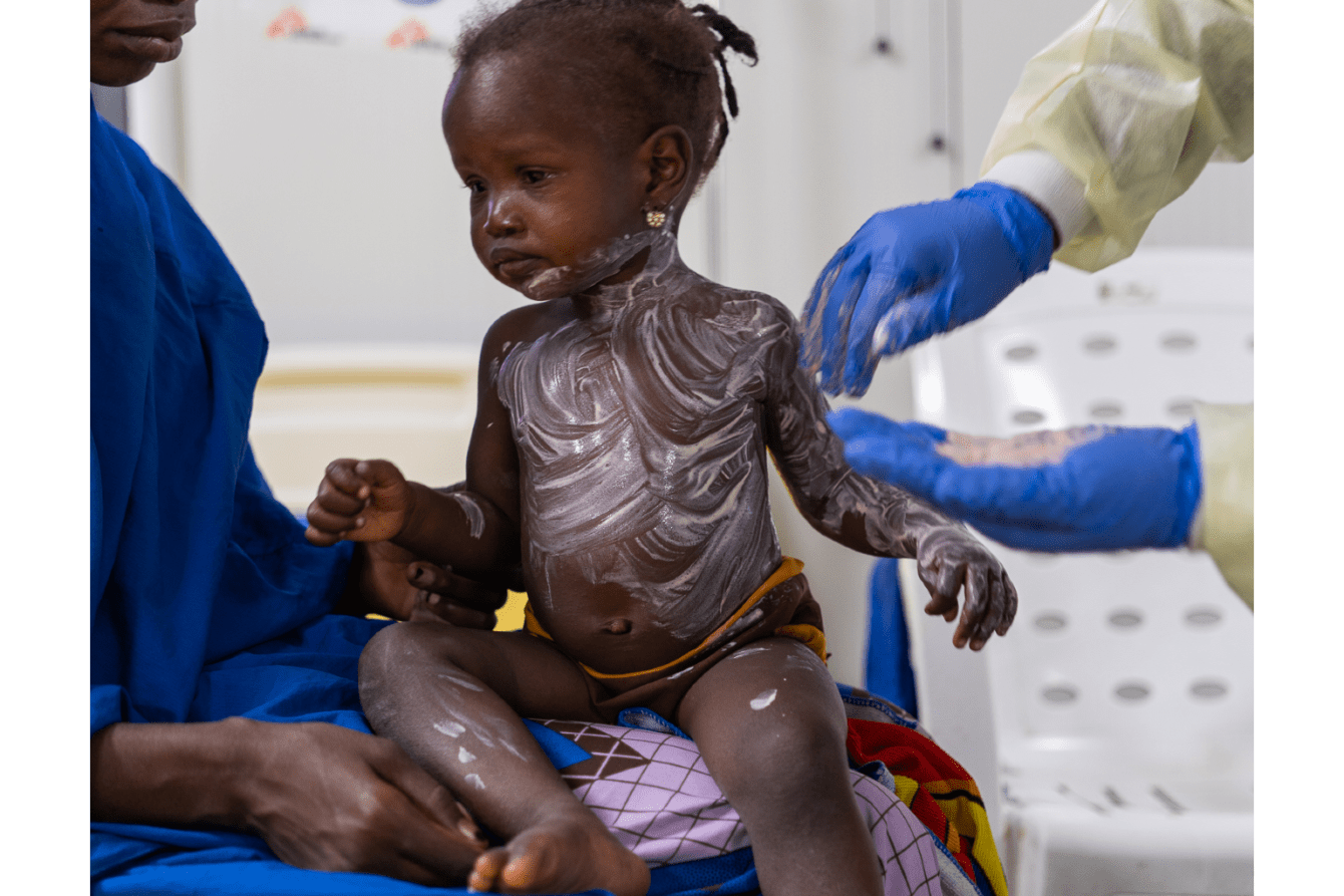 A young measles patient is treated with Zinc ointment at the MSF Nilefa Kiji facility in Maiduguri, Nigeria.