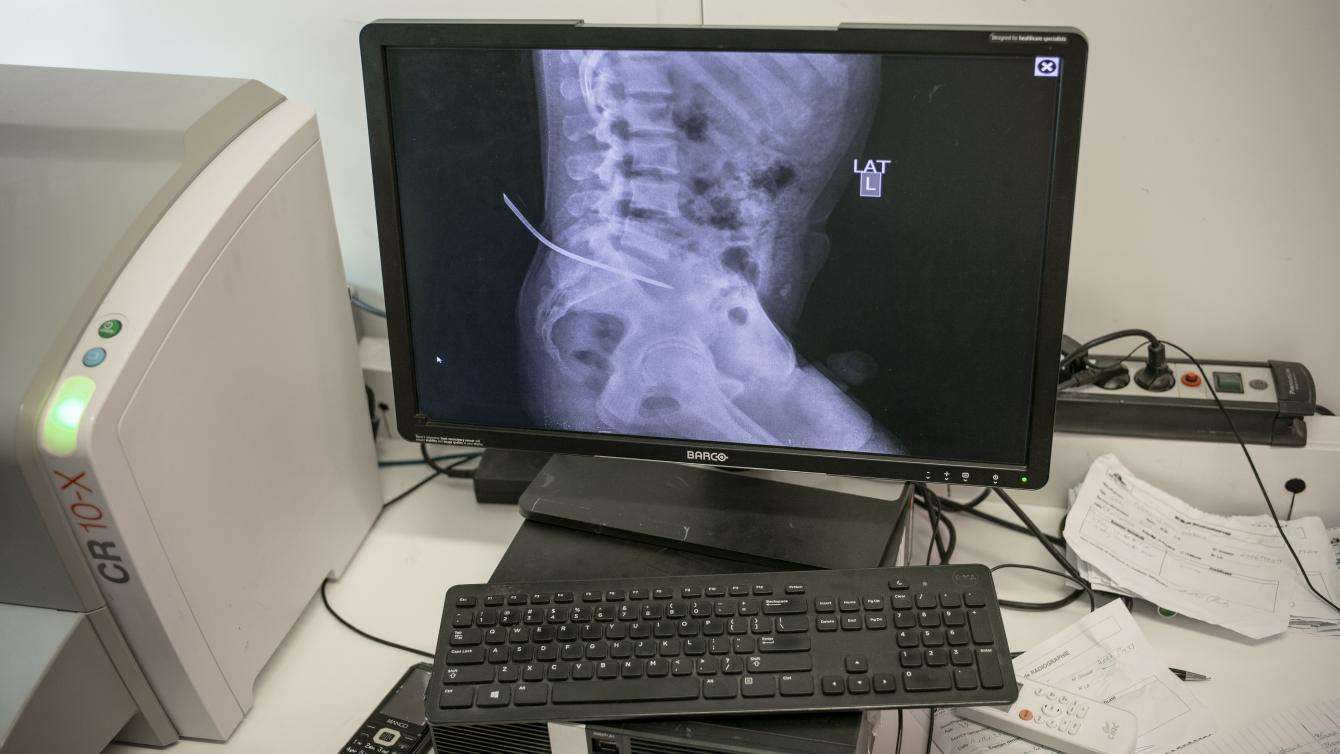 An x-ray image shows the medical damage inflicted with an attack with an ice pick.