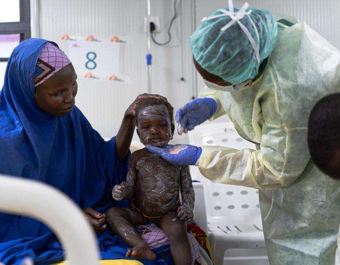 A young measles patient is treated with zinc ointment at the MSF Nilefa Kiji facility in Maiduguri, Nigeria.