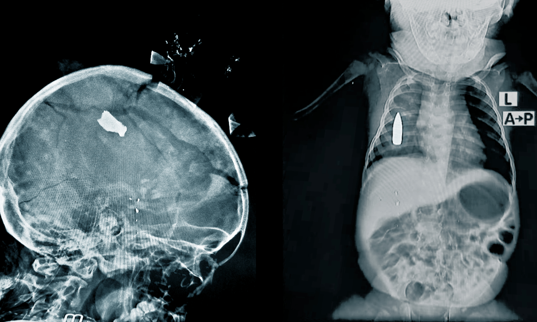 X-rays of children show dire impact of Sudan’s war | Doctors Without ...