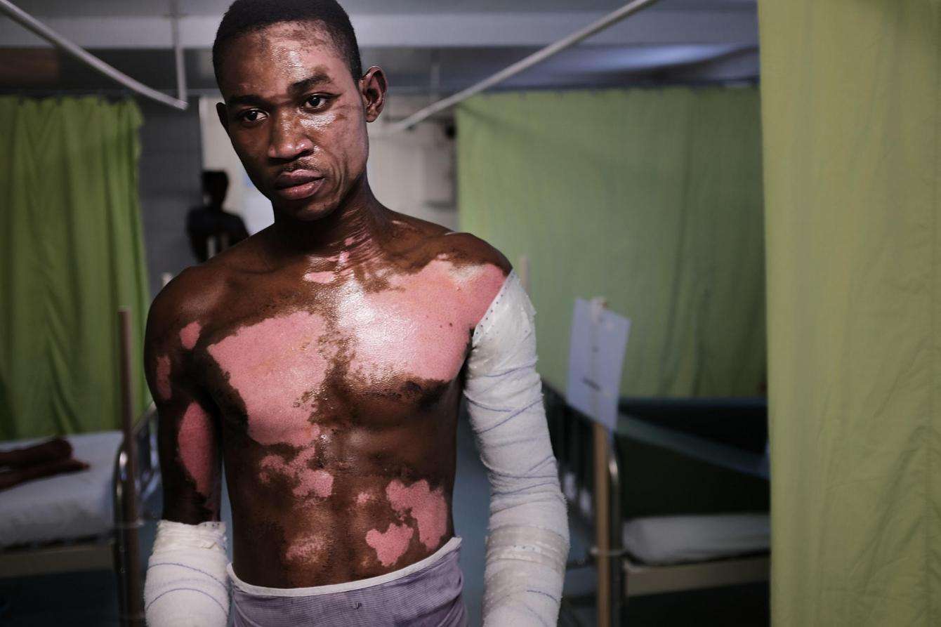 Treating Burn and Trauma Victims in Haiti