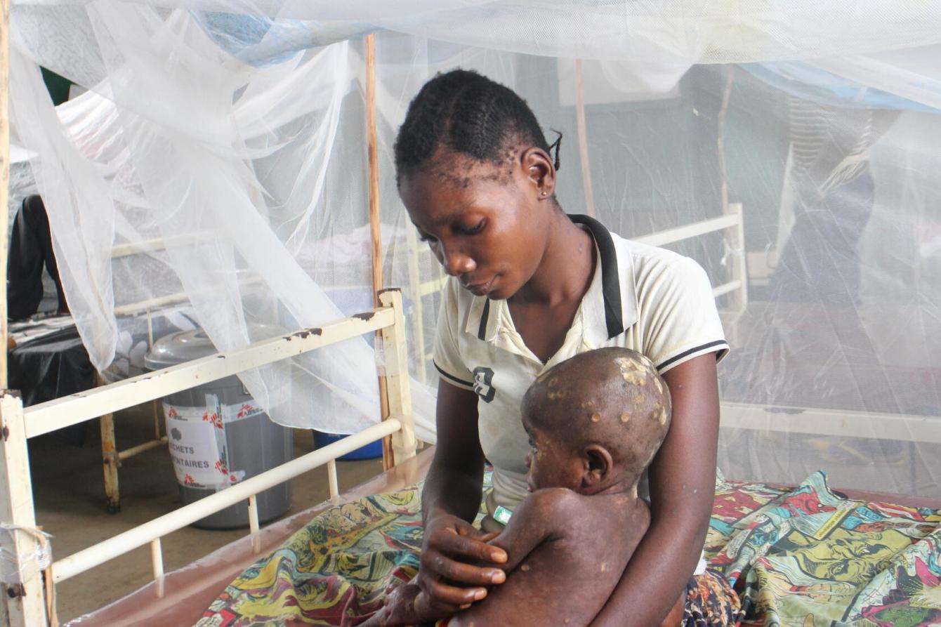 A woman holds her child who is receiving treatment for Mpox at the MSF-supported Bolomba general referral hospital in the Democratic Republic of Congo.