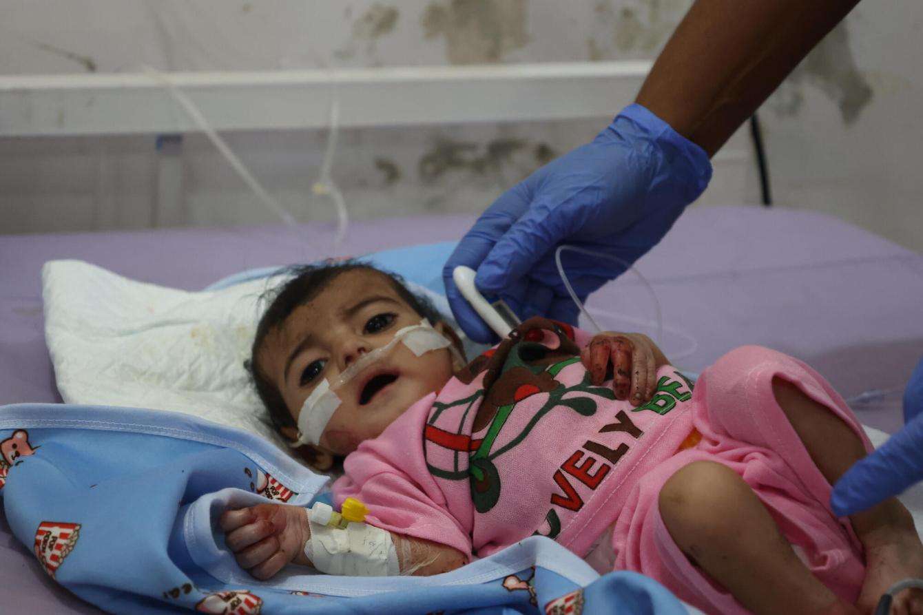 A child with severe acute malnutrition under treatment at the MSF-supported inpatient therapeutic feeding center in Abs General Hospital, Yemen.