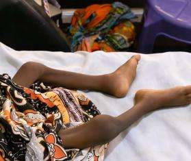 The legs of a malnourished child on a hospital bed in Nigeria.